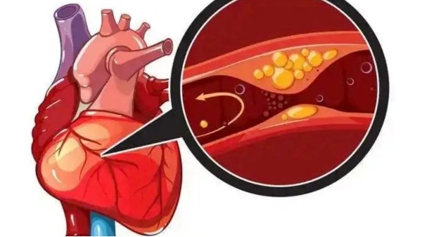 真實案例：是什么讓他堅持一年，冠狀動脈堵塞消除30%！