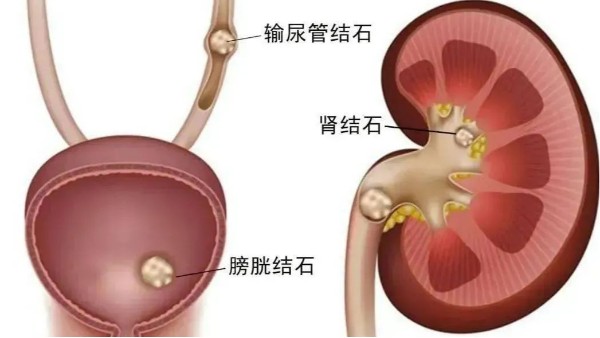 重用、活用水蛭治療尿路結(jié)石，療效較好