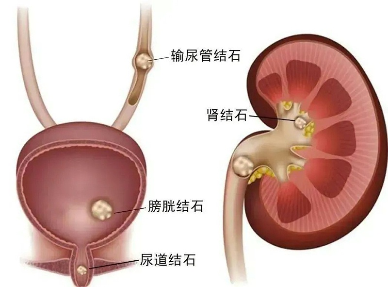 水蛭素、尿路結石、腎功能