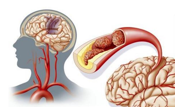 水蛭素、急性腦梗死、中風(fēng)