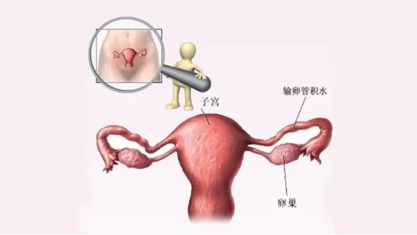 水蛭有利水道、破積聚之功，可用于治療輸卵管積水