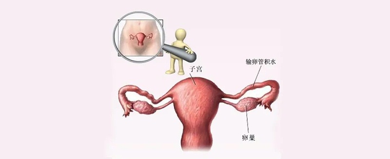 水蛭素、輸卵管積水、不孕不育