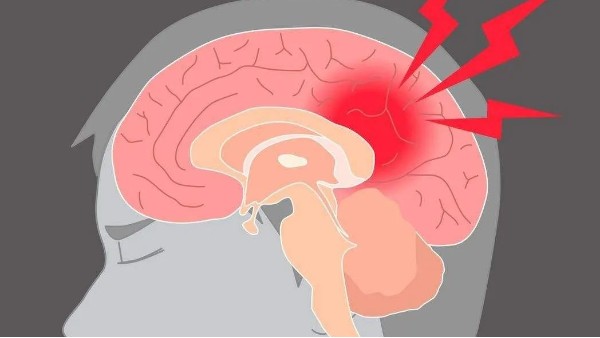 水蛭治療缺血性腦血管病療效肯定、安全簡便，已被各家公認(rèn)