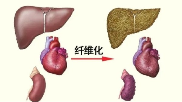 水蛭是臨床常用的活血藥物，能有效治療器官纖維化