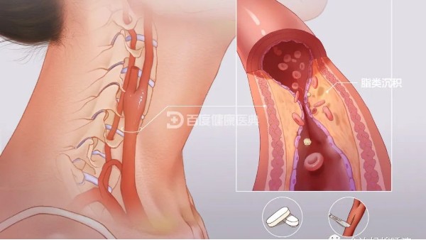 真實案例 | 從有到無，一個月多雙頸動脈斑塊“消失術(shù)”
