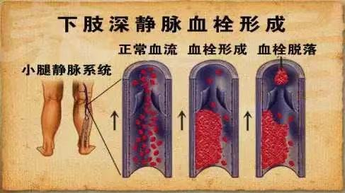 水蛭素、水蛭素膠囊、壯醫(yī)水蛭療法