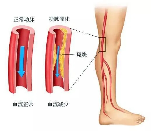 水蛭素、下肢動脈硬化、下肢閉塞