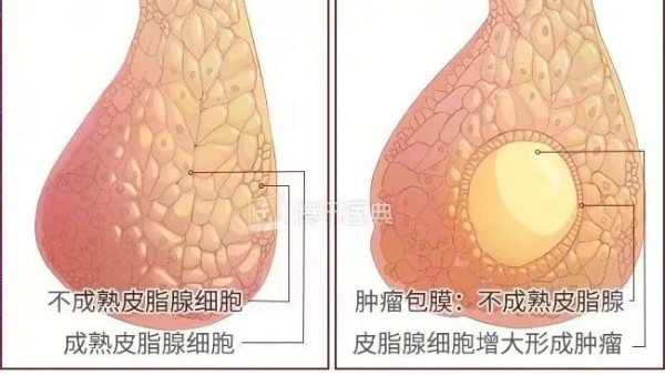 真實案例 | 腫瘤克星，百姓福音——現(xiàn)代壯醫(yī)水蛭療法