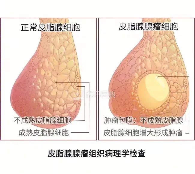 壯醫(yī)水蛭療法，天然水蛭素膠囊