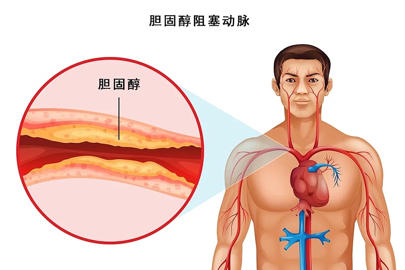 水蛭素、脖子粗、血管硬化