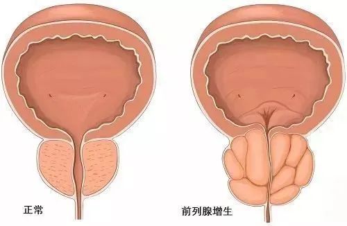 水蛭素、前列腺增生、前列腺肥大