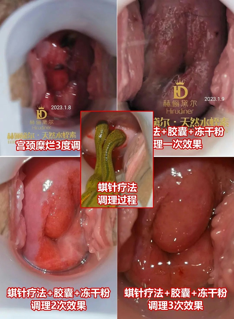 水蛭素、水蛭素膠囊、生殖婦科