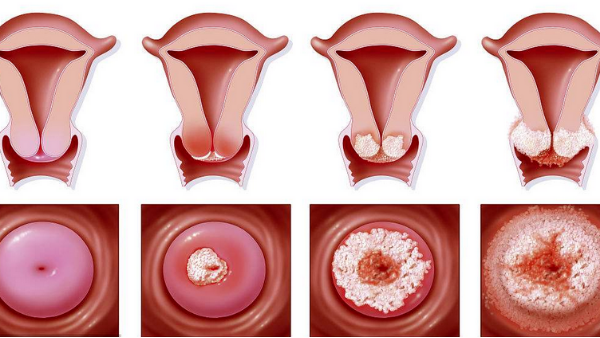 得了「宮頸糜爛」，怎么辦？