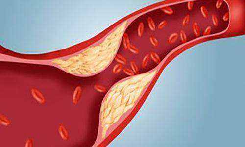 血管硬化的信號(hào)有哪些