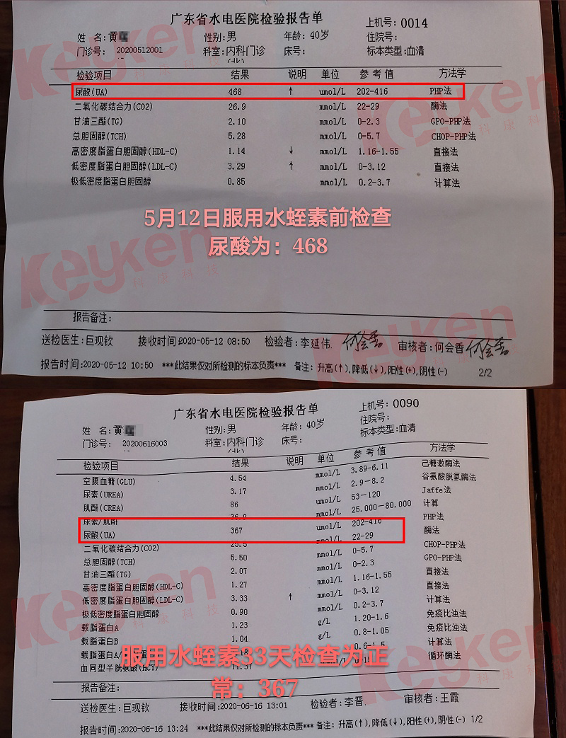 水蛭素、尿酸、痛風(fēng)