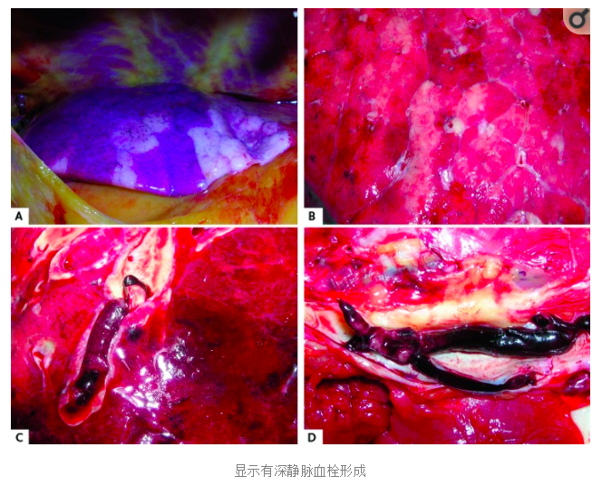 水蛭素、陽(yáng)康、烏梅、壯醫(yī)水蛭療法