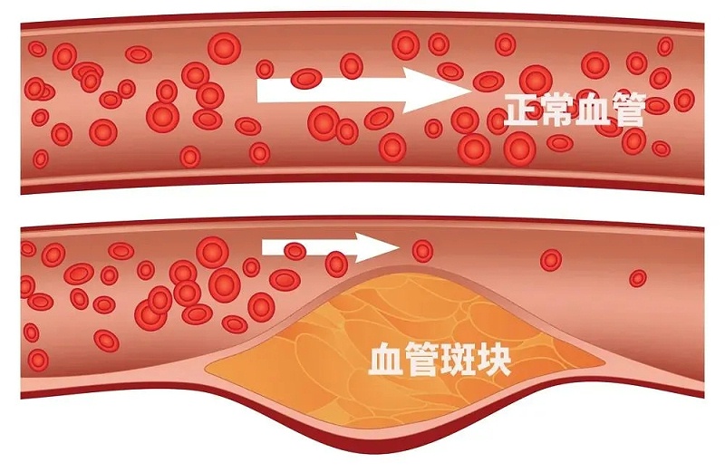 水蛭素、通血管、血管堵塞