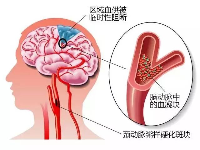 腦梗塞有什么預(yù)防方法