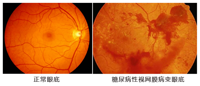 水蛭素、糖尿病、視網(wǎng)膜病變