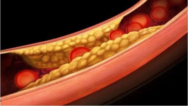 三高如何引起動脈粥樣硬化斑塊？——高血壓篇