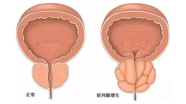 水蛭在改善前列腺增生臨床癥狀、提高生活質(zhì)量方面發(fā)揮重要作用