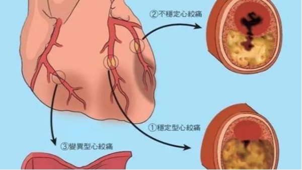 尿酸高不僅導致痛風，還可能威脅你的心臟和大腦！