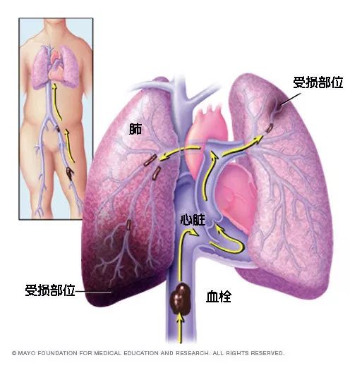 水蛭素、猝死、心梗